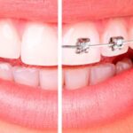 ortodoncia-y-brackets